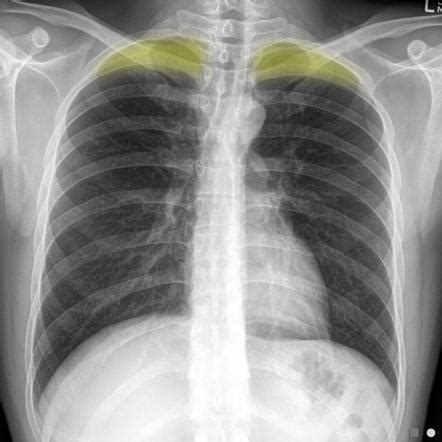 apicolordotic x ray|Apical zone .